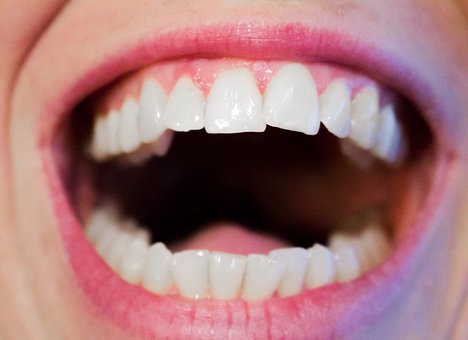 Teeth Whitening, Is It A Safe Option Or Not?